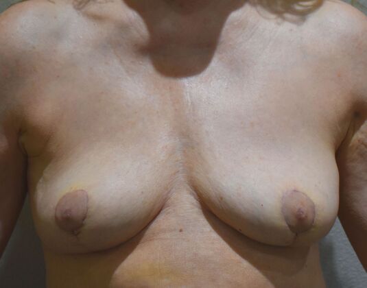 Breast Implant Removal: Case 61 - After