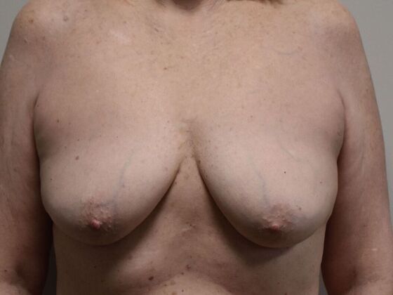 Breast Augmentation w/ Lift Case 618 - Before