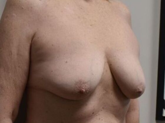 Breast Augmentation w/ Lift: Case 618 - Before