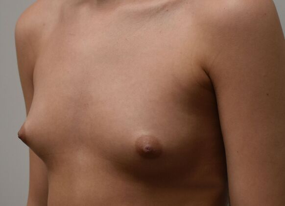 Breast Augmentation w/ Lift: Case 598 - Before