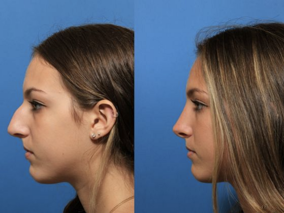 Rhinoplasty Cases