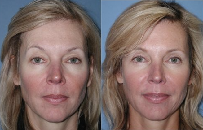 Blepharoplasty Cases