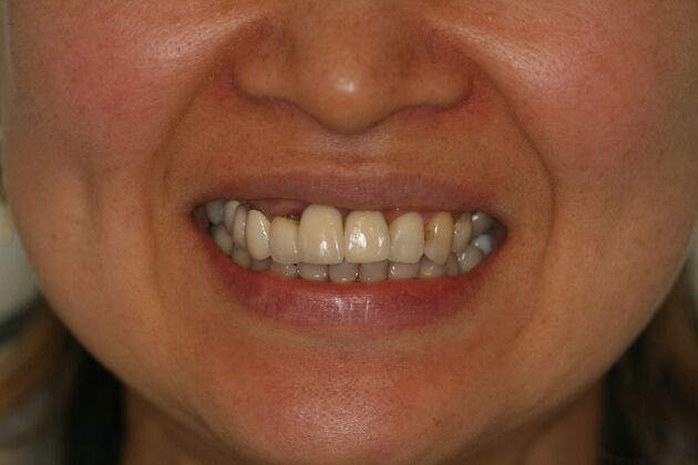 Porcelain Veneers Case 8 - Before