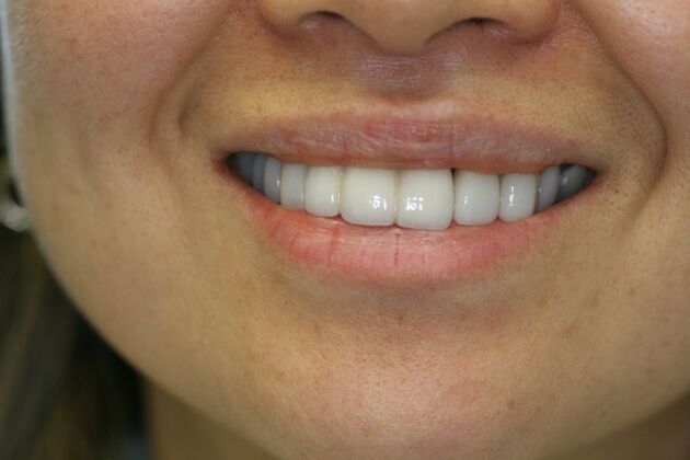 Porcelain Veneers Case 8 - After