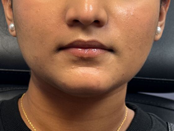 Cosmetic Injectables & Fillers*: Case 65 - Before