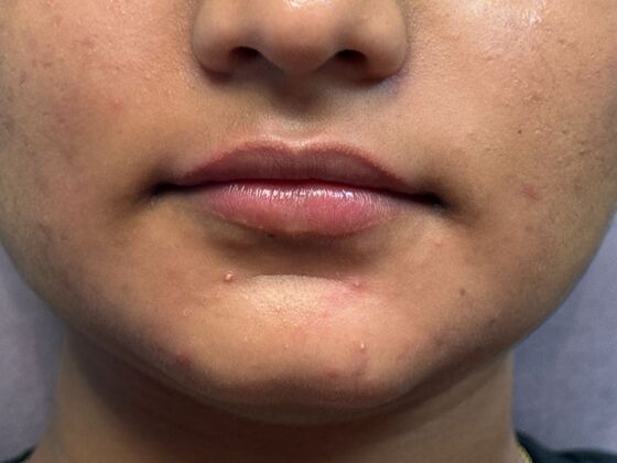 Cosmetic Injectables & Fillers*: Case 65 - After