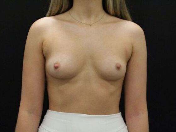 Breast Augmentation Case 122 - Before