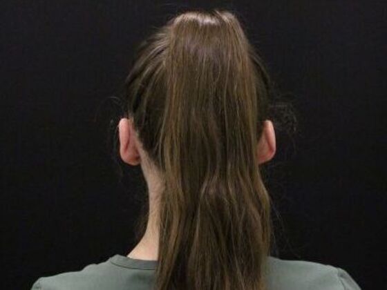 Ear Surgery - Otoplasty: Case 5 - After