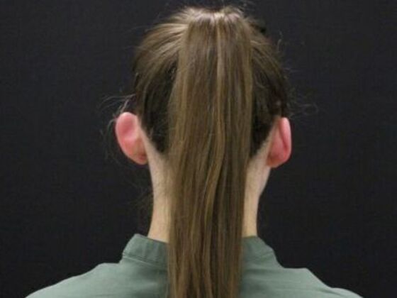 Ear Surgery - Otoplasty: Case 5 - Before