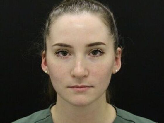 Ear Surgery - Otoplasty Case 5 - After