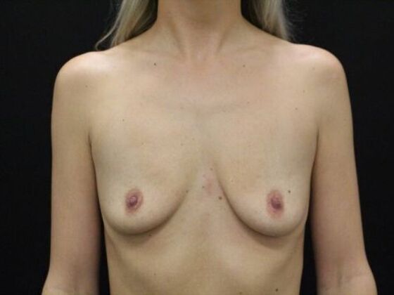 Breast Augmentation Case 123 - Before