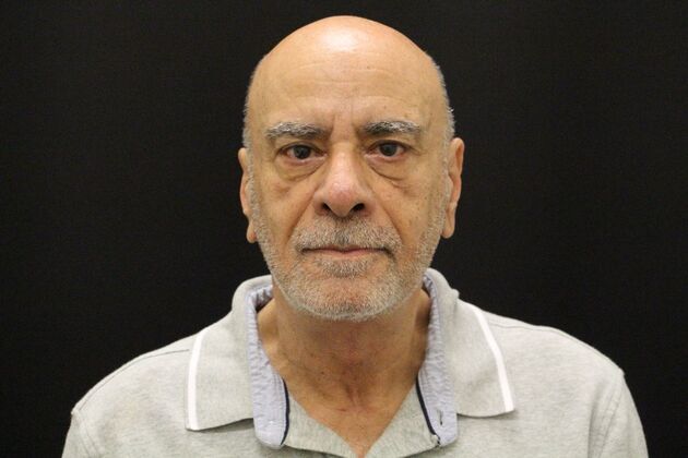 Face & Neck Lifts: Case 6 - After