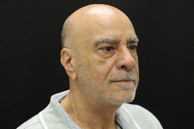 Face & Neck Lifts: Case 6 - After