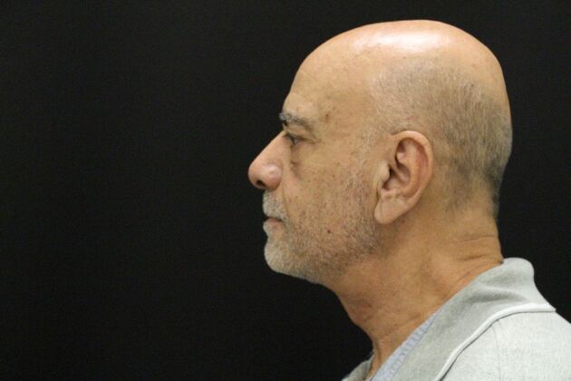 Face & Neck Lifts: Case 6 - After