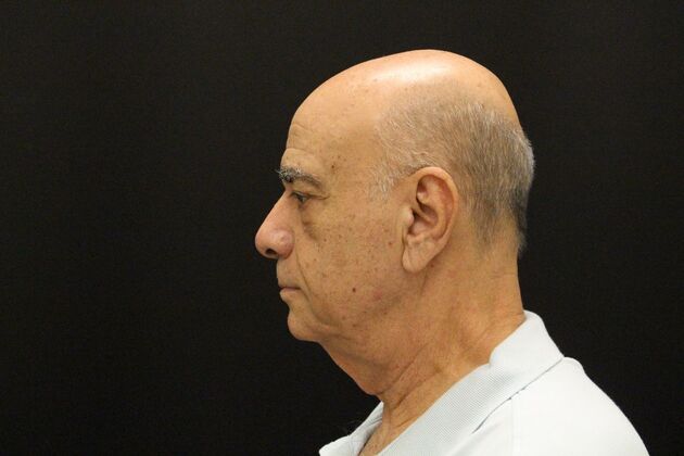 Face & Neck Lifts: Case 6 - Before