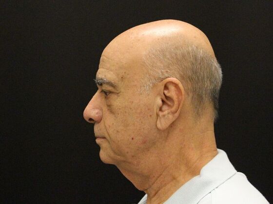 Face & Neck Lifts: Case 6 - Before