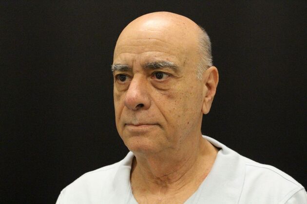 Face & Neck Lifts: Case 6 - Before