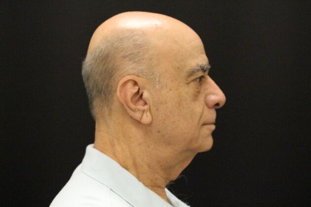 Face & Neck Lifts Case 6 - Before