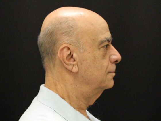 Face & Neck Lifts Case 6 - Before