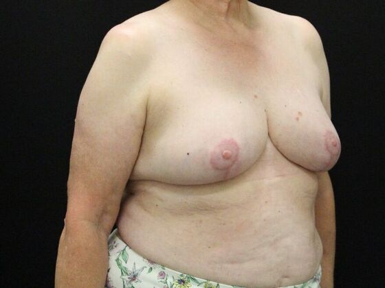 Breast Reduction & Lift: Case 37 - After