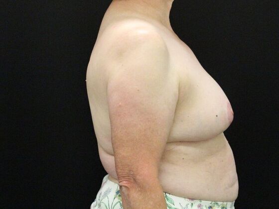 Breast Reduction & Lift: Case 37 - After