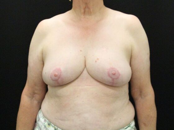 Breast Reduction & Lift Case 37 - After