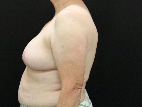 Breast Reduction & Lift: Case 37 - After