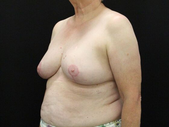 Breast Reduction & Lift: Case 37 - After