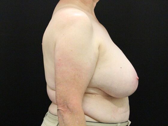 Breast Reduction & Lift: Case 37 - Before