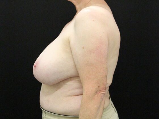 Breast Reduction & Lift: Case 37 - Before