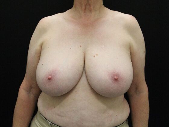 Breast Reduction & Lift Case 37 - Before