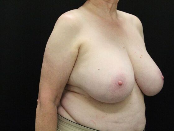 Breast Reduction & Lift: Case 37 - Before