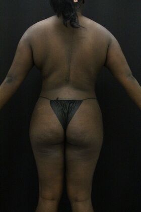 Liposuction: Case 66 - After