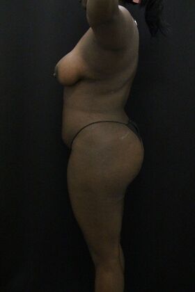 Liposuction: Case 66 - After