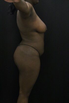 Liposuction: Case 66 - After