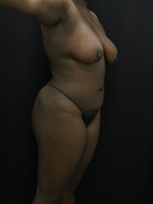 Liposuction: Case 66 - After