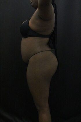 Liposuction: Case 66 - Before