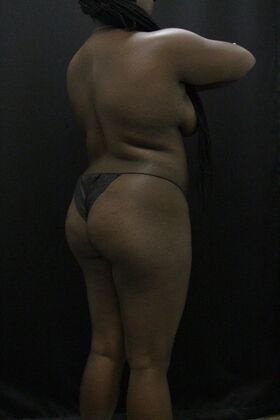 Liposuction: Case 66 - Before