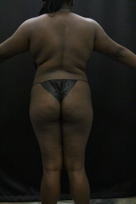 Liposuction: Case 66 - Before