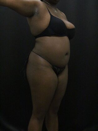 Liposuction: Case 66 - Before