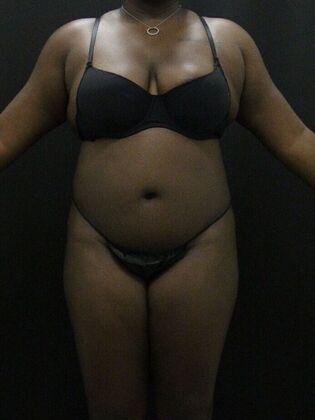 Liposuction Case 66 - Before