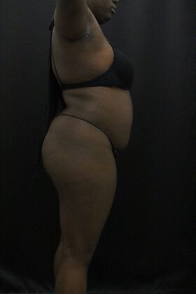 Liposuction: Case 66 - Before