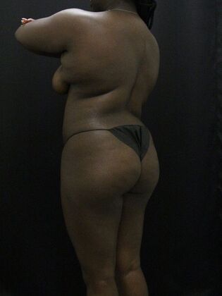 Liposuction: Case 66 - Before