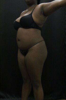 Liposuction: Case 66 - Before