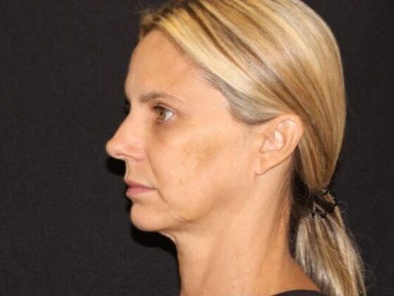 Injectables Case 98 - Before