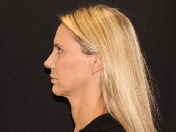 Injectables: Case 98 - After