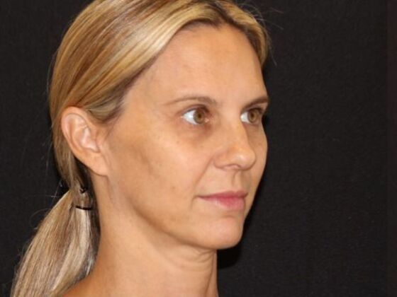 Injectables: Case 98 - Before