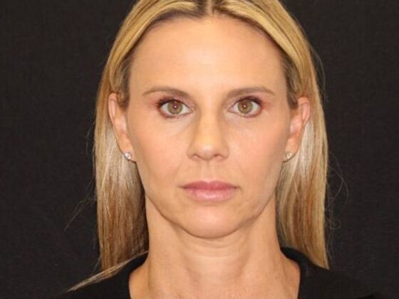 Injectables: Case 98 - After