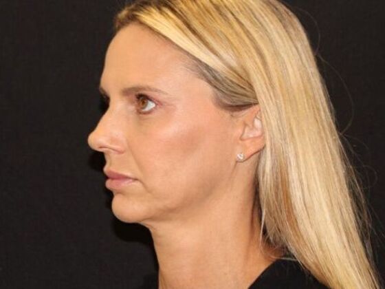 Injectables Case 98 - After