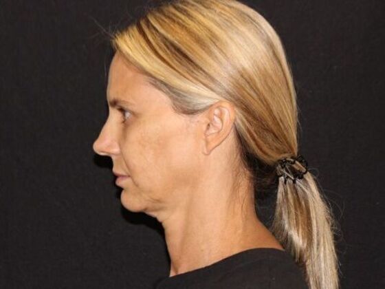 Injectables: Case 98 - Before